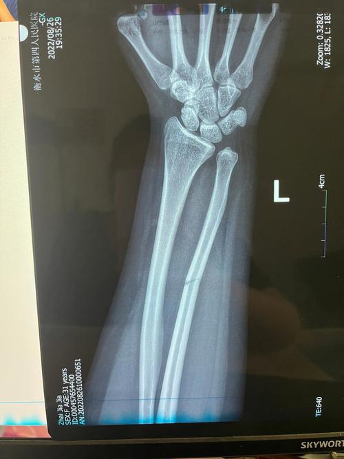 佩佩左臂骨折